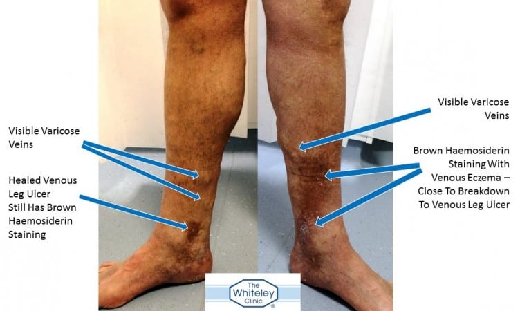 Patient with Healed Leg Ulcer Right and Venous Eczema Left - Curable By The Whiteley Protocol&reg; - The Whiteley Clinic