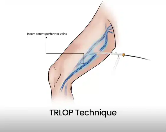 The TRLOP Technique at The Whiteley Clinic
