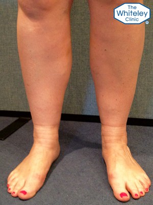 Swollen ankle with varicose veins and stock imprints - CEAP C3