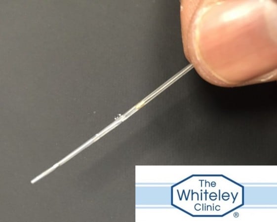 IVUS Intravascular Ultrasound Tip For Pelvic Vein Problems at The Whiteley Clinic November 2014