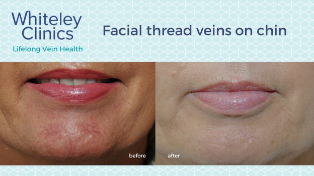 Before and after photos showing successful chin thread veins treatment