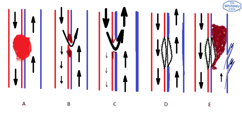 Arterio-venous fistula diagrams