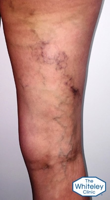 Typical pelvic vein varicose veins on rear of thigh with old phlebitis brown staining right