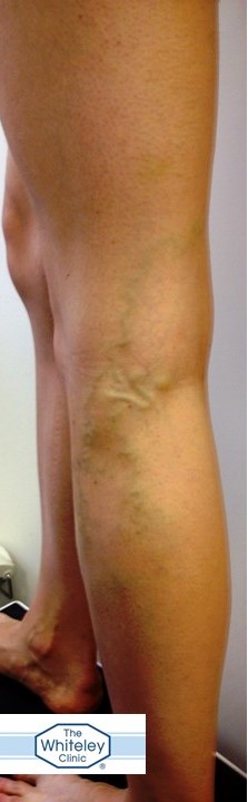 varicose veins increases risk of DVT by 5 times
