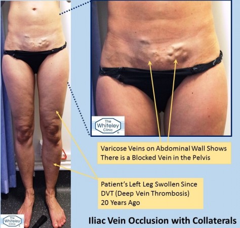 Pelvic vein blockage - Iliac vein occlusion - causing a swollen leg and abdominal collateral varicose veins - The Whiteley Clinic