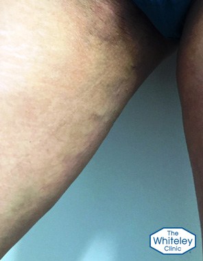 Typical paravulvar varicose veins due to pelvic varicose veins causing varicose veins in the legs right side