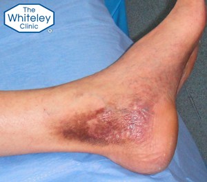 Venous leg ulcer healed by endovenous treatment using The Whiteley Protocol - CEAP-C5