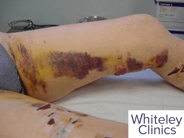 Bruising after varicose vein stripping treatment, a method that is not recommend by The Whiteley Clinic.