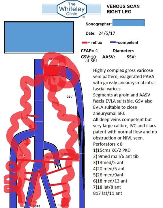 Varicose Veins in patients who are told that their veins are "too bad to treat" - treated by Whiteley Protocol