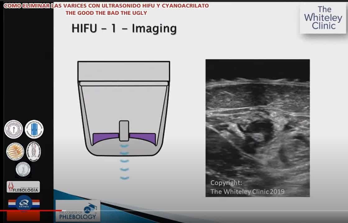 Cartoon explaining HIFU Treatment of Varicose Veins &ndash; Webinar 13 August 2020