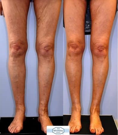 Recurrent varicose veins both after stripping 10 years ago - treated successfully by The Whiteley Protocol - Front