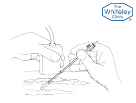 Diagram showing the TRLOP (TRansLuminal Occlusion of Perforator technique)