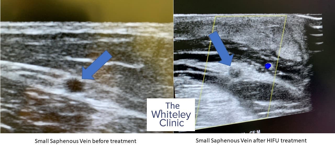 Before and after ultrasound pictures of a small saphenous vein closed with HIFU Echotherapy with Sonovein