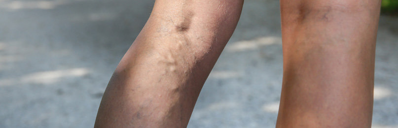 varicose vein facts
