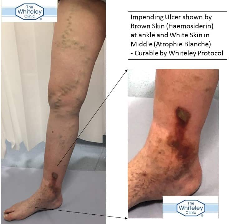 Impending leg ulcer secondary to recurrent varicose veins and perforators