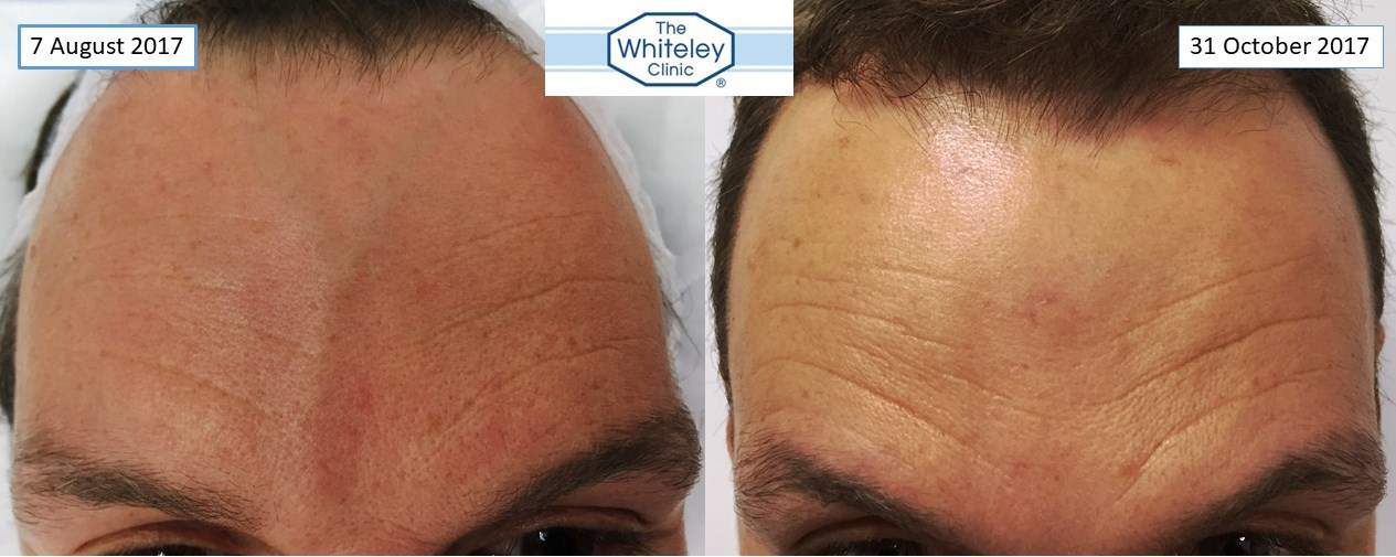 Forehead vein removal - facial veins removed at The Whiteley Clinic