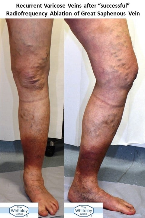 Recurrent Varicose Veins after "Successful" Radiofrequency Ablation of Great Saphenous Vein elsewhere