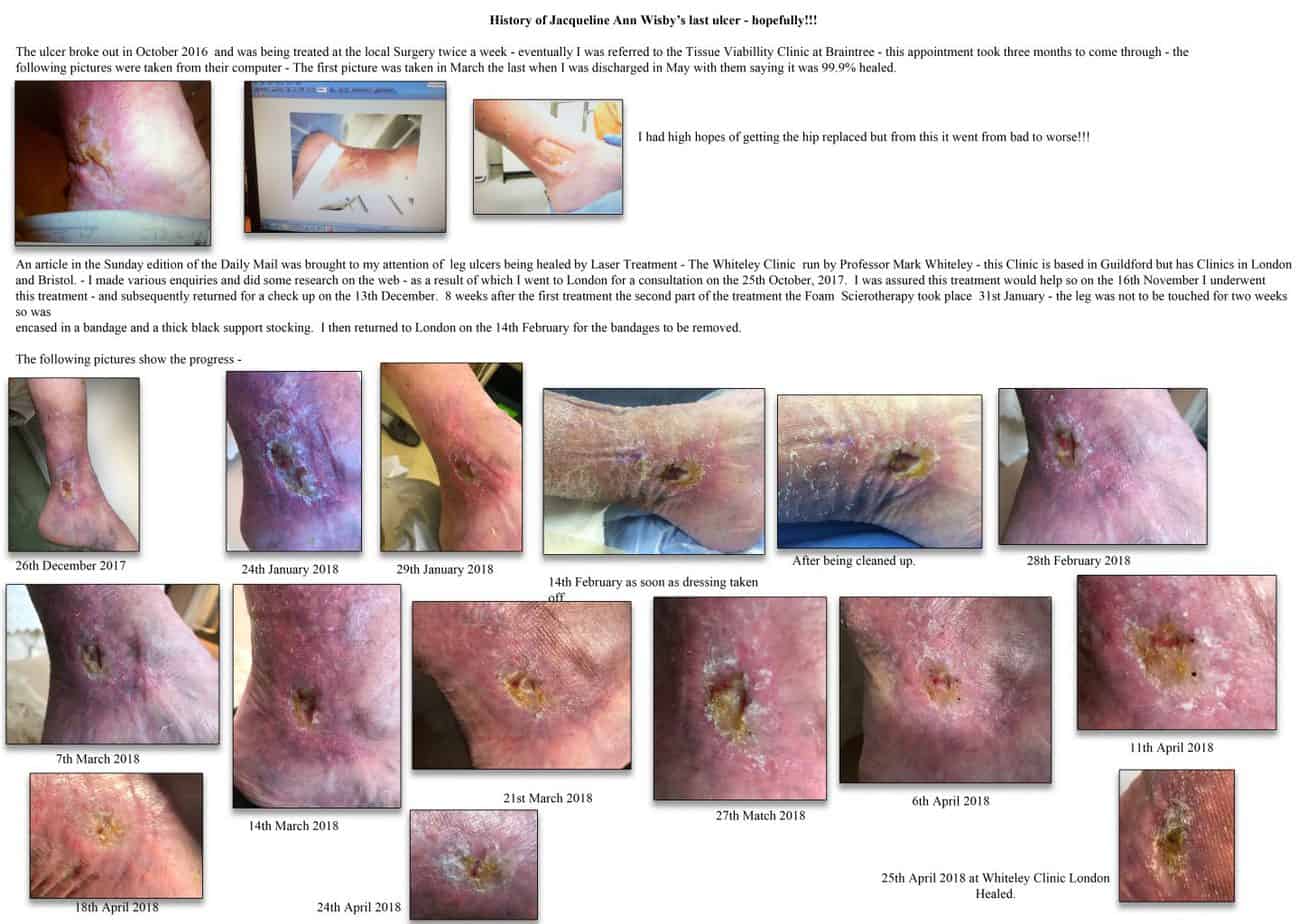 History of Leg Ulcer by Jacqueline Ann Wisby