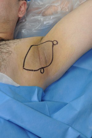 Laser sweat treatment - called Laser Sweat Ablation (LSA) - for excessive sweating takes just over one hour and is performed under local anaesthetic - LSA was developed by Prof Mark Whiteley