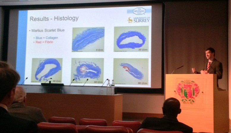 Laser for Varicose Veins - Prize winning research presented by Henry Ashpitel of The Whiteley Clinic and University of Surrey - Royal Society of Medicine 28 May 2015