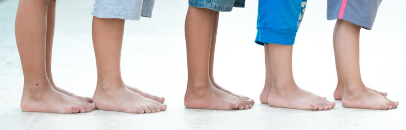 Varicose Veins in children
