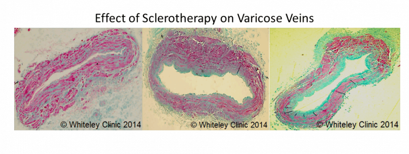 Effect of Sclerotherapy on Varicose Veins - original research from The Whiteley Clinic