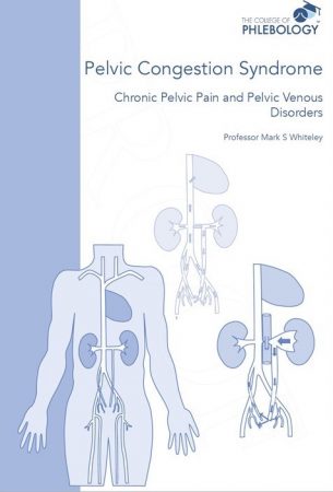 Pelvic congestion syndrome -chronic pelvic pain and pelvic venous disorders ISBN 9781908586070