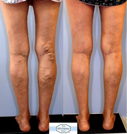 Recurrent varicose veins both after stripping 10 years ago - treated successfully by The Whiteley Protocol - back