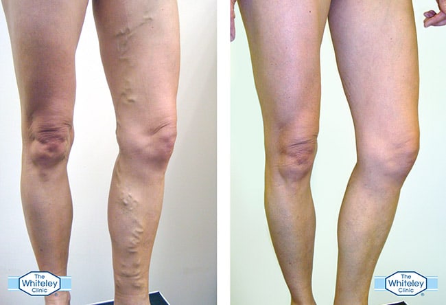 Before and after photos of a varicose veins patient treated at The Whiteley Clinic by Mr Barrie Price