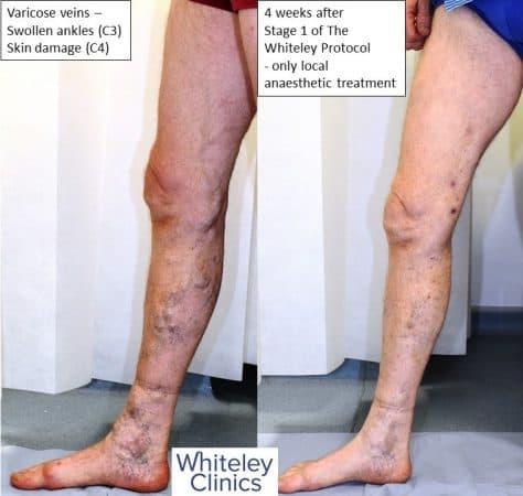 Large varicose veins swollen ankles and haemosiderin skin damage cured by The Whiteley Protocol local anaesthetic endovenous surgery - medial leg