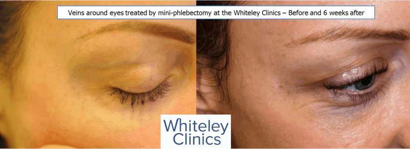 Veins around eyes removed by mini-phlebectomy by Prof Mark Whiteley at The Whiteley Clinic - Facial Veins