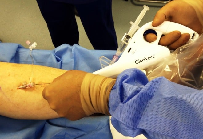 First Clarivein (MOCA) case for varicose veins done at The Whiteley Clinic, Bond Street, London