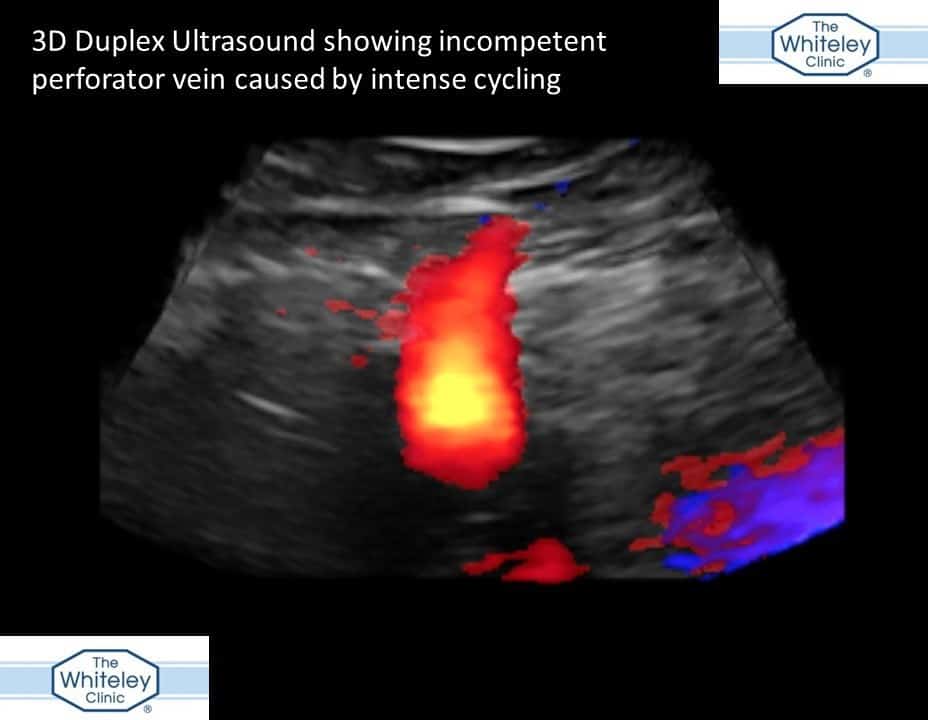 Varicose veins caused by intense cycling - perforator incompetence 3D duplex - The Whiteley Clinic Nov 2017