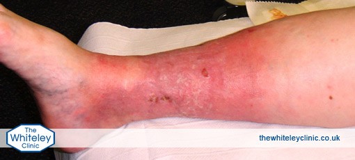 Severe inflammation caused by phlebitis