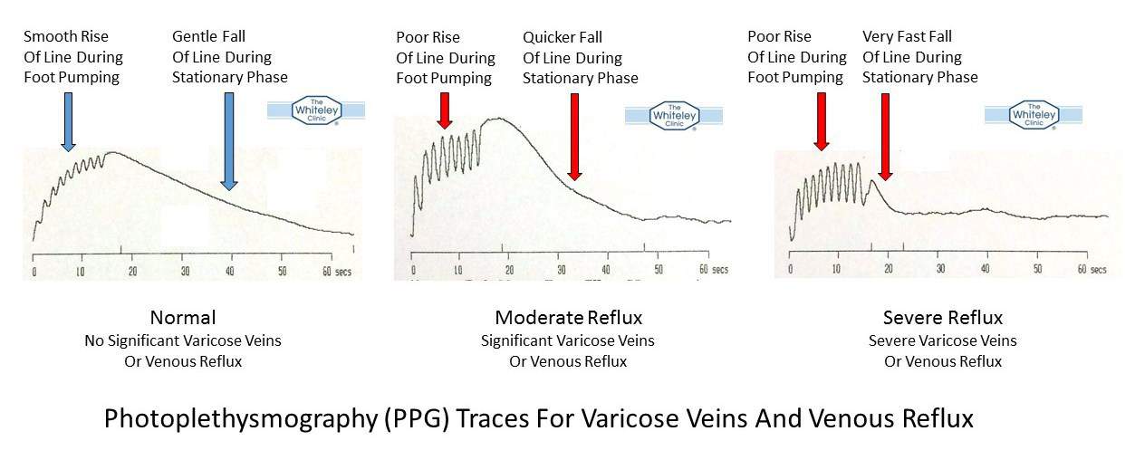 Photoplethysmography (PPG) traces - How PPG shows normal veins from varicose veins and severe venous reflux