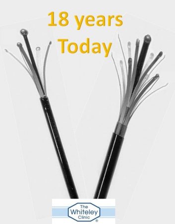 endovenous varicose veins surgery 18 years old today - first case in UK by Mark Whiteley on 12 March 1999