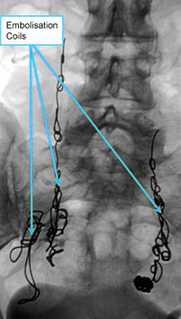 A venogram showing embolisation coils in pelvic veins