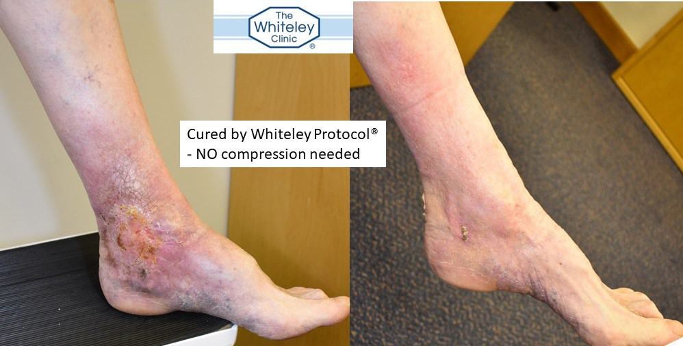 Venous Leg Ulcer cured by Whiteley Protocol - no compression needed - The Whiteley Clinic