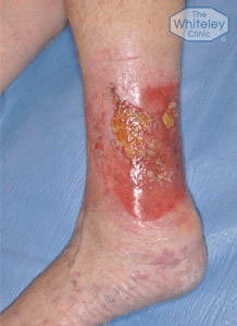Leg Ulcers