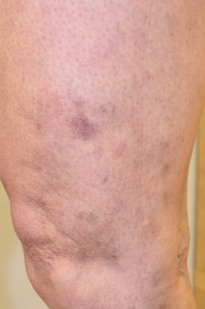 Spider veins on legs and matting resistant to treatment - Should have had a duplex scan