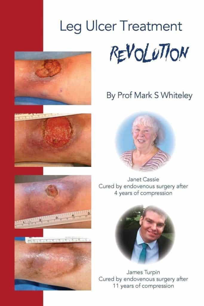 Leg Ulcer Treatment Revolution &ndash; by Prof Mark S Whiteley