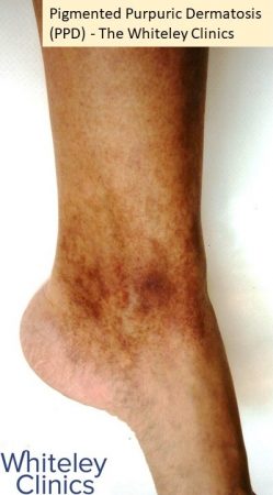 Pigmented purpuric dermatosis PPD pigmented dermatosis left ankle medial - The Whiteley Clinic