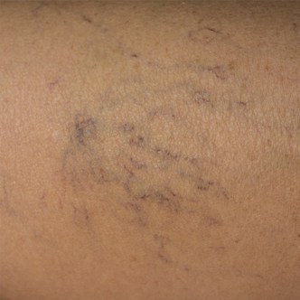 Thread veins, veins, vein health, varicose veins, spider veins, broken beins