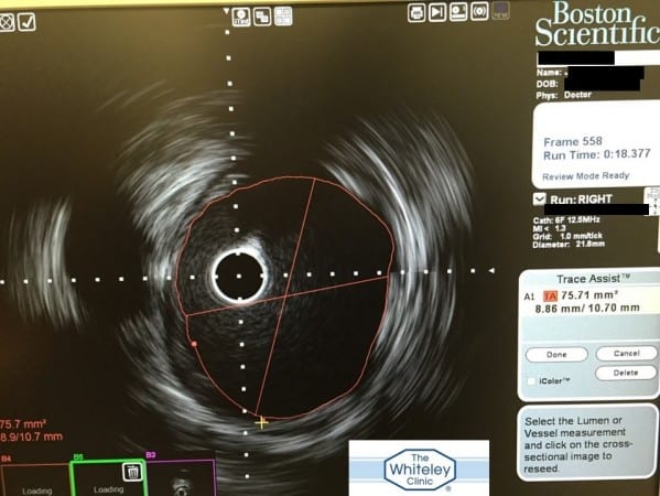 Example of the Boston Scientific IVUS Intravascular Ultrasound used at The Whiteley Clinic November 2014
