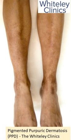 Pigmented purpuric dermatosis PPD pigmented dermatosis from front - The Whiteley Clinic