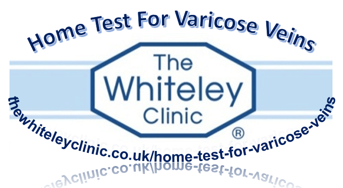 Simple Test For Varicose Veins at Home