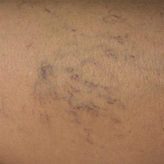 Close up of visible symptoms of thread veins