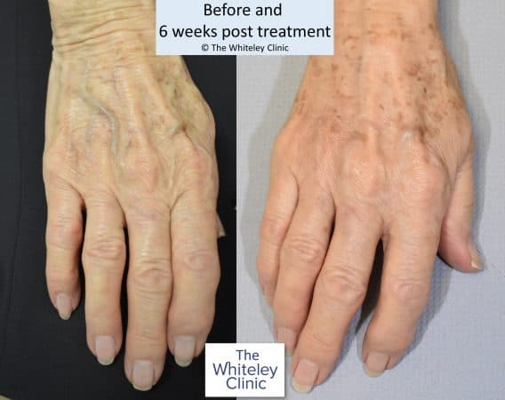 Right hand vein removal at The Whiteley Clinic &ndash; Before and After &ndash; Mark Whiteley