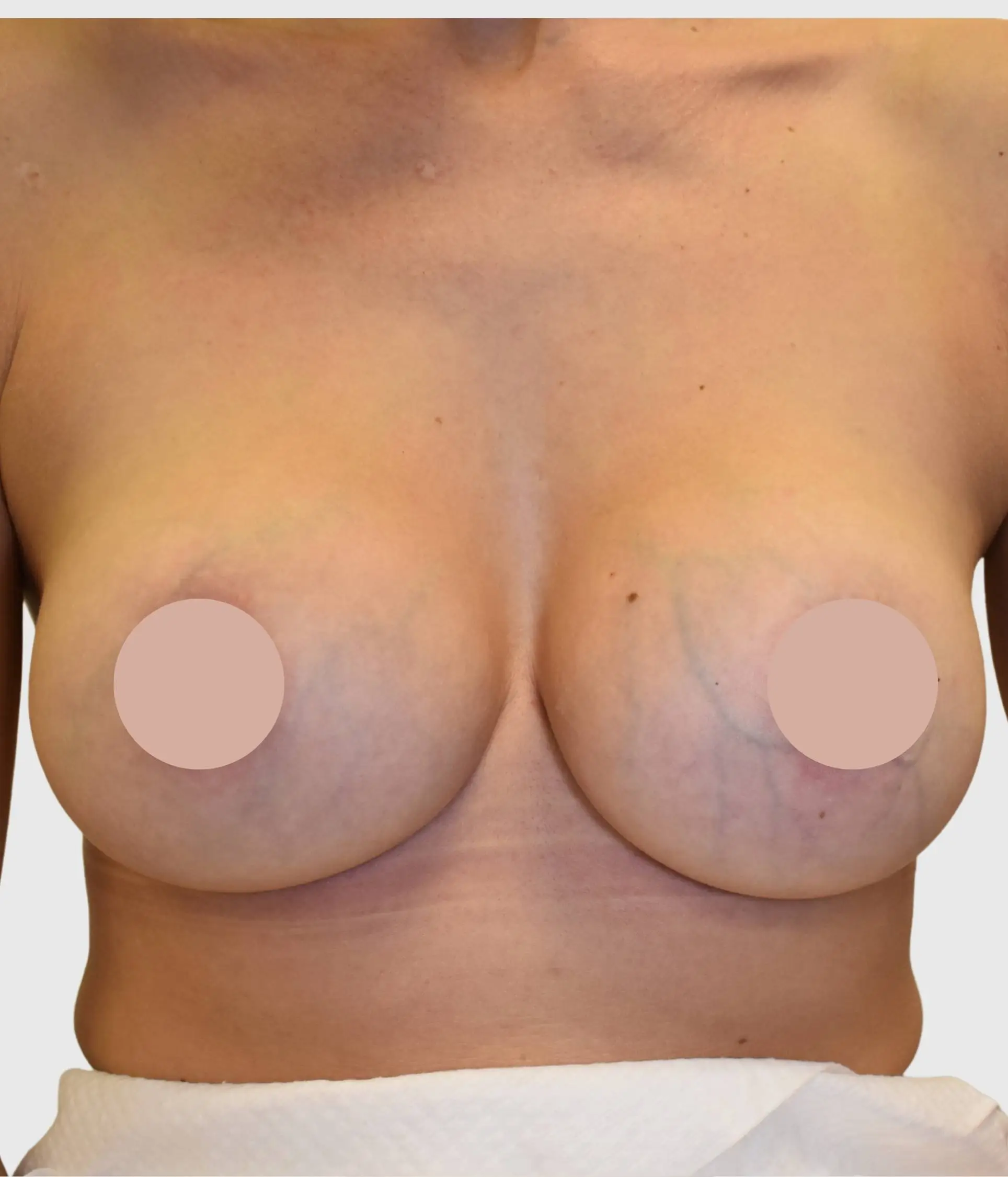 Breast and Chest Veins