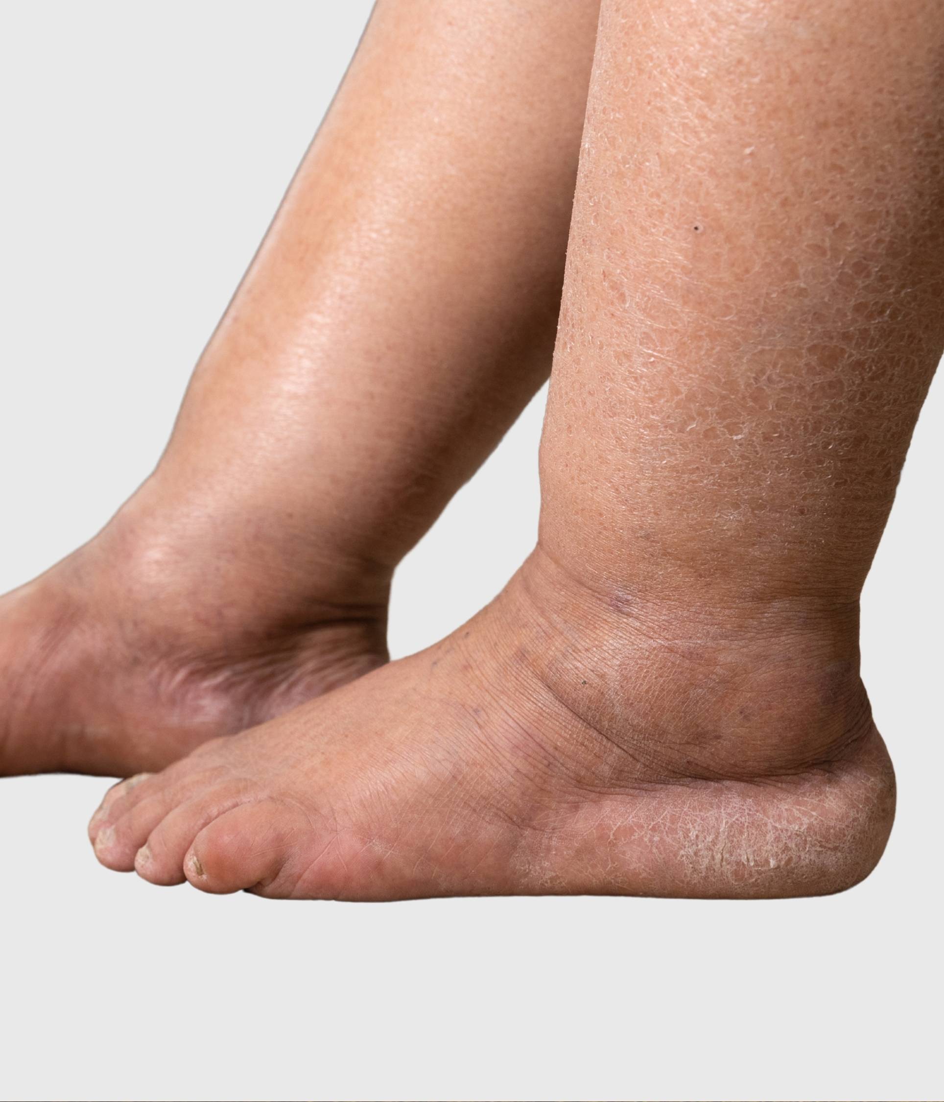 Deep Vein Thrombosis